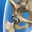 hip-replacement-surgery