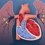 causes-of-pulmonary-hypertension