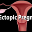 when-does-ectopic-pregnancy-pain-start