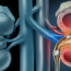 kidney stone symptoms and treatment