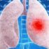 lung cancer in men