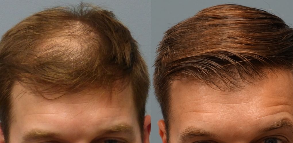 What is the Hair Transplant Cost in India? 2023 Updated